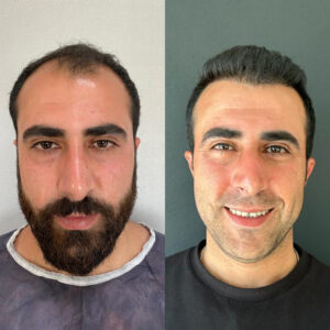 Haartransplantation Antalya Vorher- Nachher