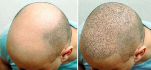 Before- After Hair transplantation Izmir- Turkey