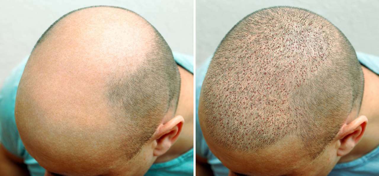 Vorher-Nachher Haartransplantation in Izmir